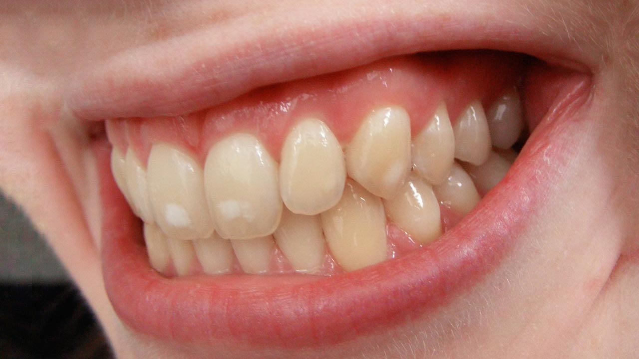baby teeth discoloration fall