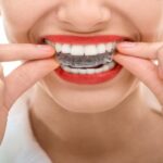 AGE LIMIT TO Invisalign TREATMENTS