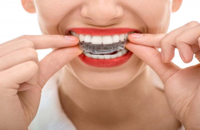 AGE LIMIT TO Invisalign TREATMENTS