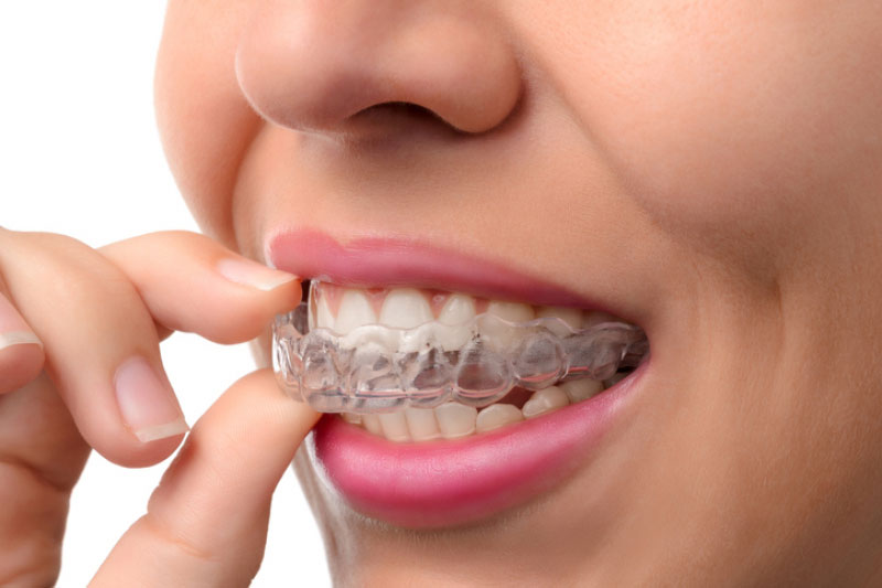 BEST AGE FOR Invisalign