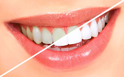 Whiten teeth before after