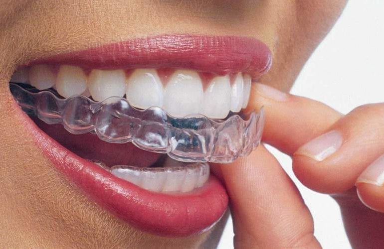 Smily face with Invisalign or Braces