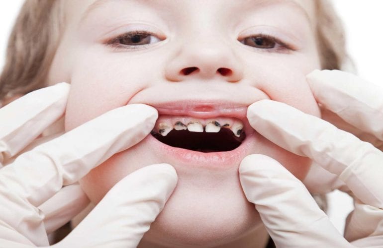 Child Tooth Decay