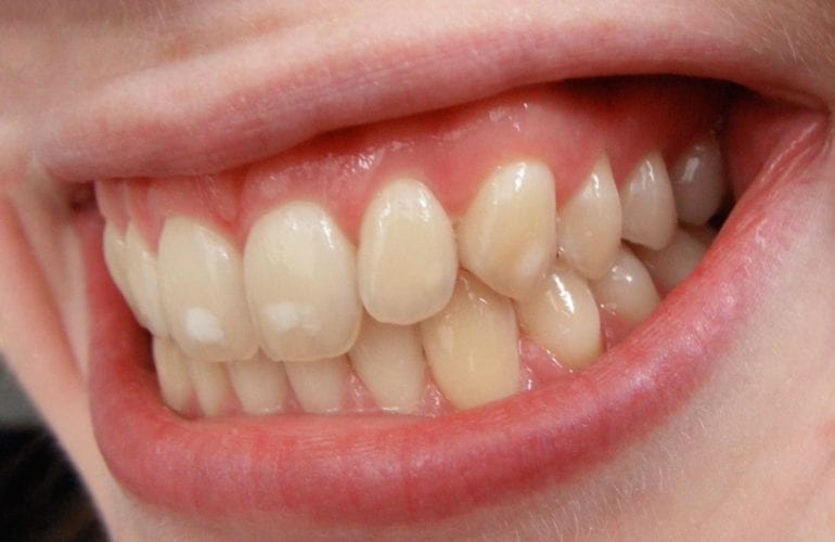fluorosis on baby teeth