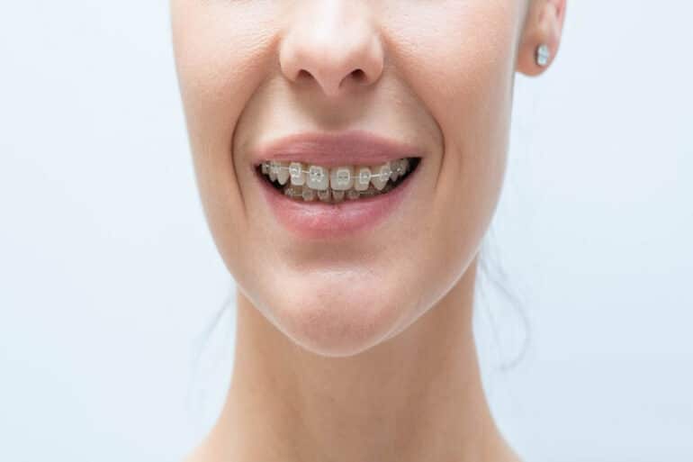 What is a Deep Bite in Orthodontics? - Kakar Dental Group