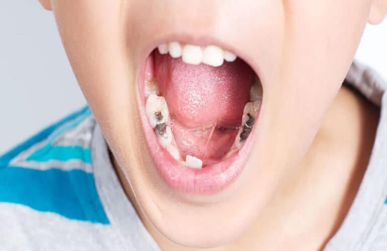 Why Filling Cavities in Kids Is not Optional