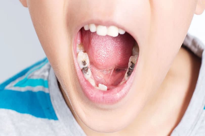 Why Filling Cavities in Kids Is not Optional