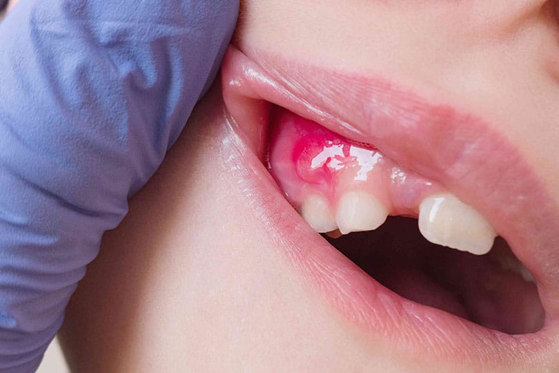 Gum Abscess Pops
