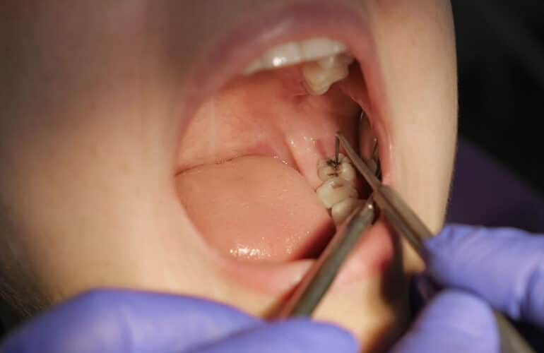 Wisdom Teeth Stitches Coming Out